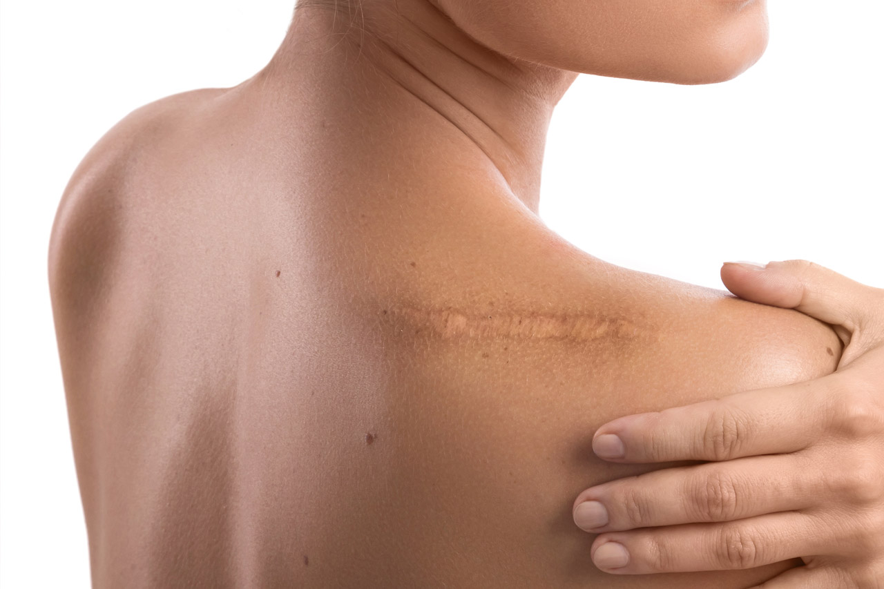 Cicatrice chéloïde : les meilleures traitements pour les atténuer : Femme  Actuelle Le MAG