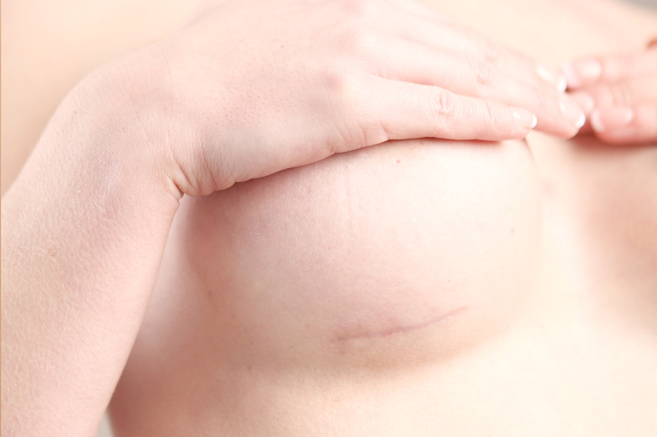 Cicatrice réduction mammaire