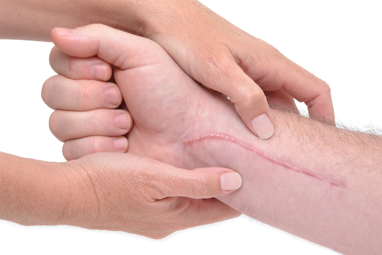 Cicatrice chéloïde : traitement des cicatrices